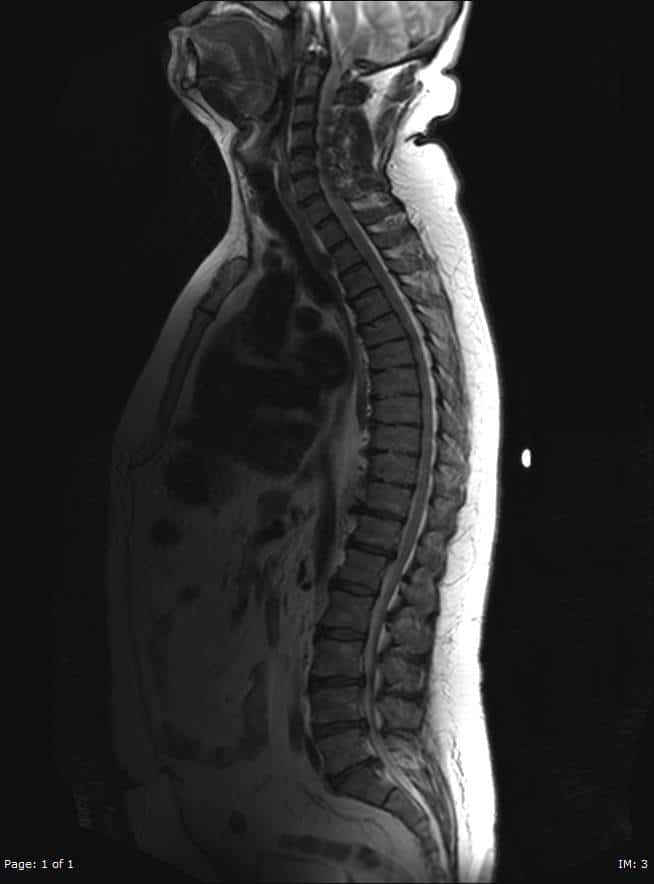MRI Spine