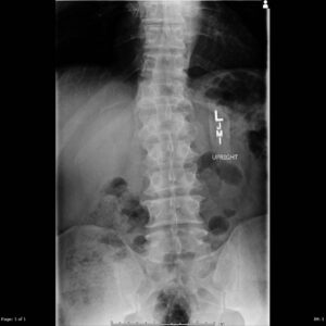 X-Ray Spine-Pelvis